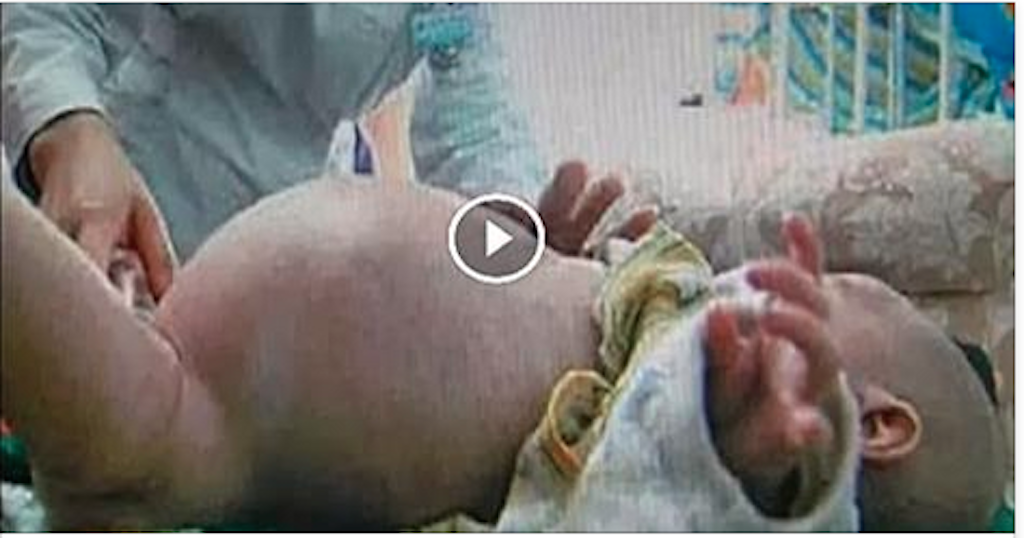 Incredible child of 2 years gives birth to his twin!! [video shock]