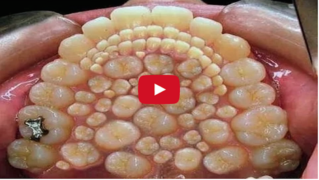 Doctors remove 232 TEETH from boy's MOUTH in a Record-Breaking operation