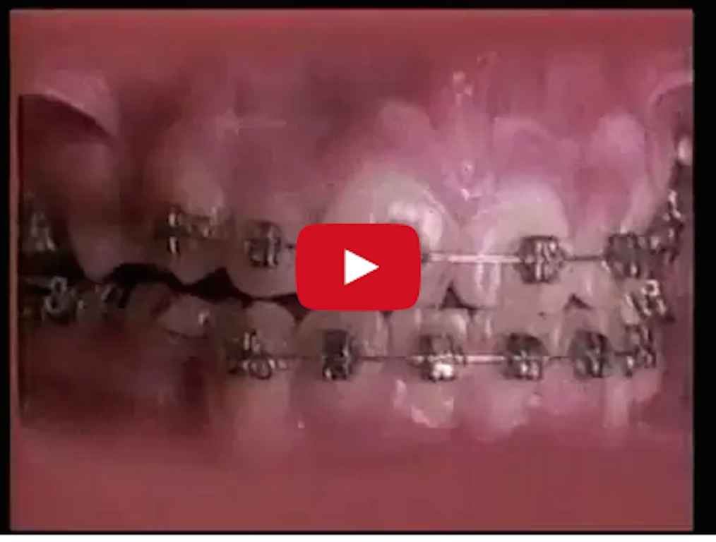 Have You Ever Had Braces? This Time Lapse Video Shows Exactly What's Going On In Your Mouth!