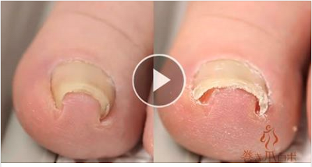Here is the best method for treating the fingernails Incarnite!!! Incredible